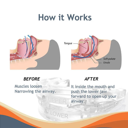 Protetor Bucal MOKARLE Anti-Ronco / Bruxismo // Melhora o Sono / Apneia / Dentes // Dispositivo Noturno para Parar de Roncar